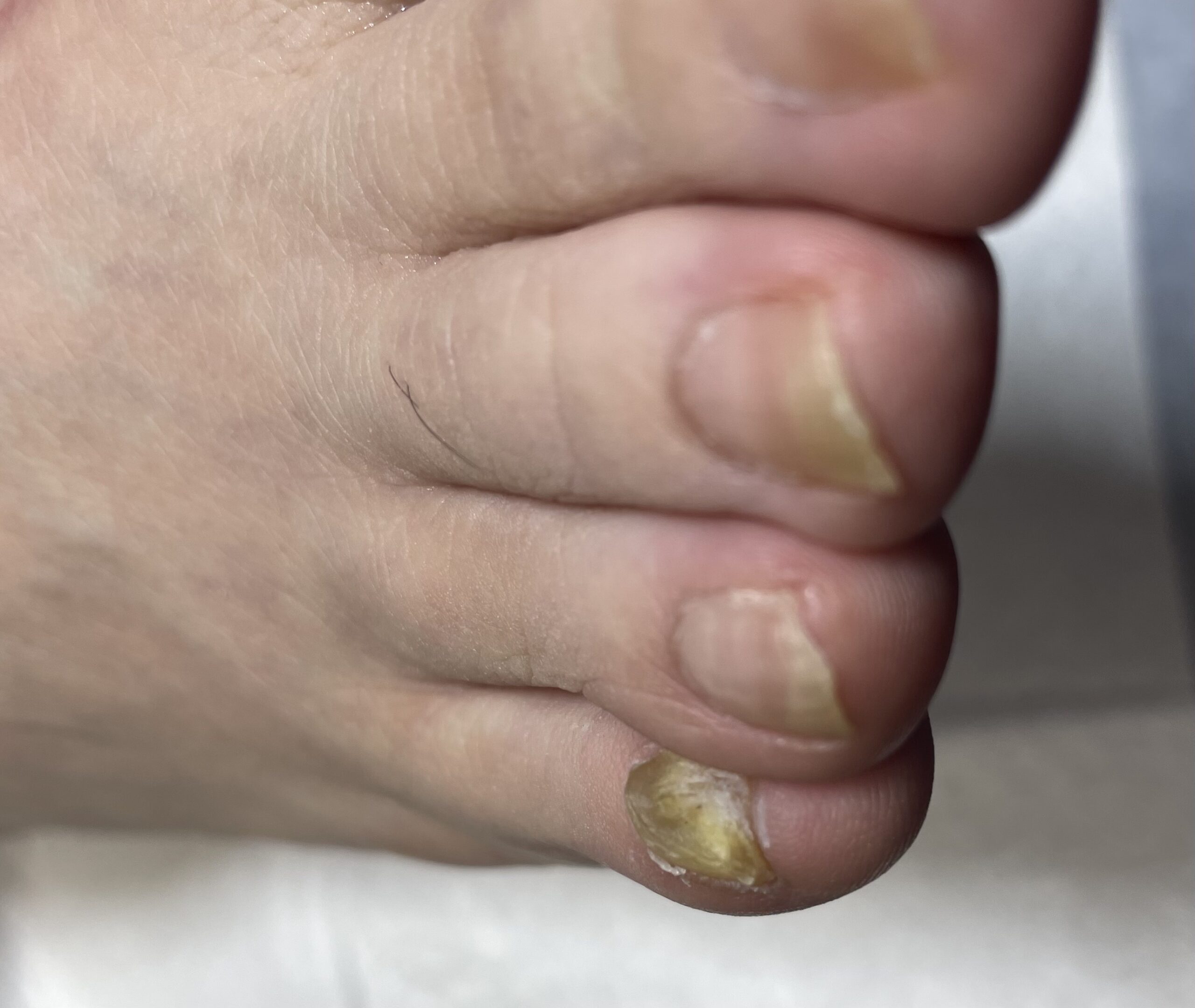 左足の小指の爪 足の小指の爪が外向きになってる 捻れ小指さん！ 今すぐ小指を